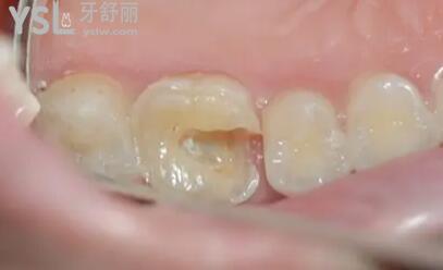 補牙樹脂材料有幾種類型.jpg