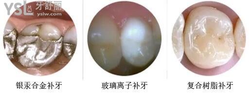 補牙樹脂材料有幾種類型.jpg