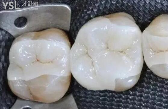 嵌體修復(fù).jpg