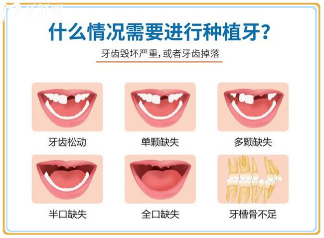 什么情況下需要種植牙