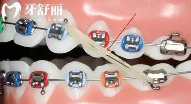 自鎖托槽矯正技術(shù).jpg