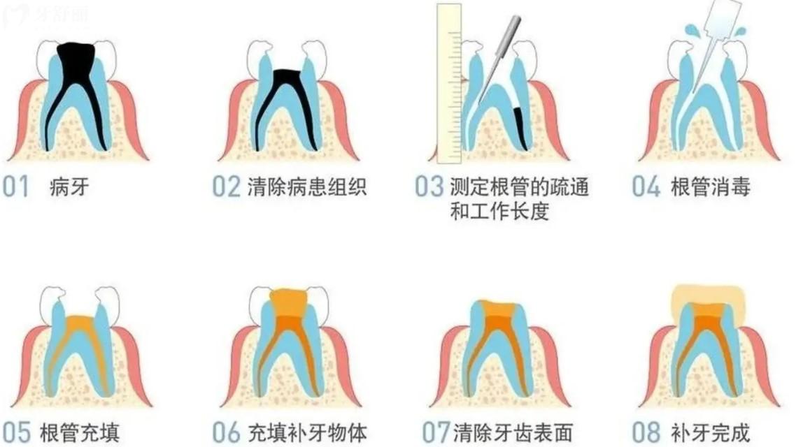 根管治療