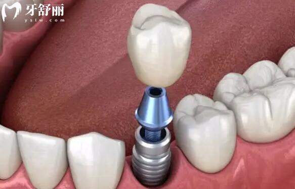 德國(guó)icx種植牙是什么檔次的?.jpg
