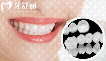 全瓷冠