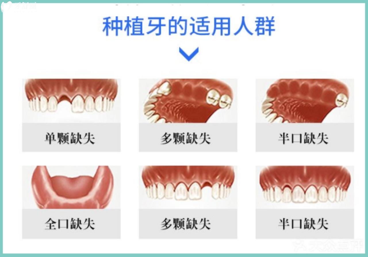 種植牙適合哪些人群？