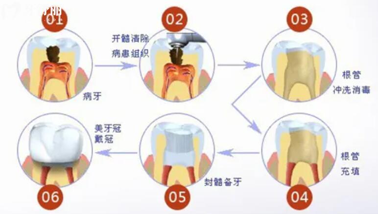 做過根管治療的牙齒多久可以吃辣