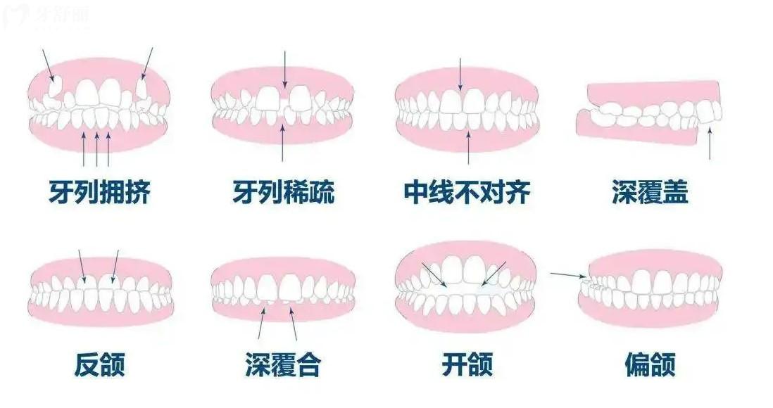 牙齒畸形