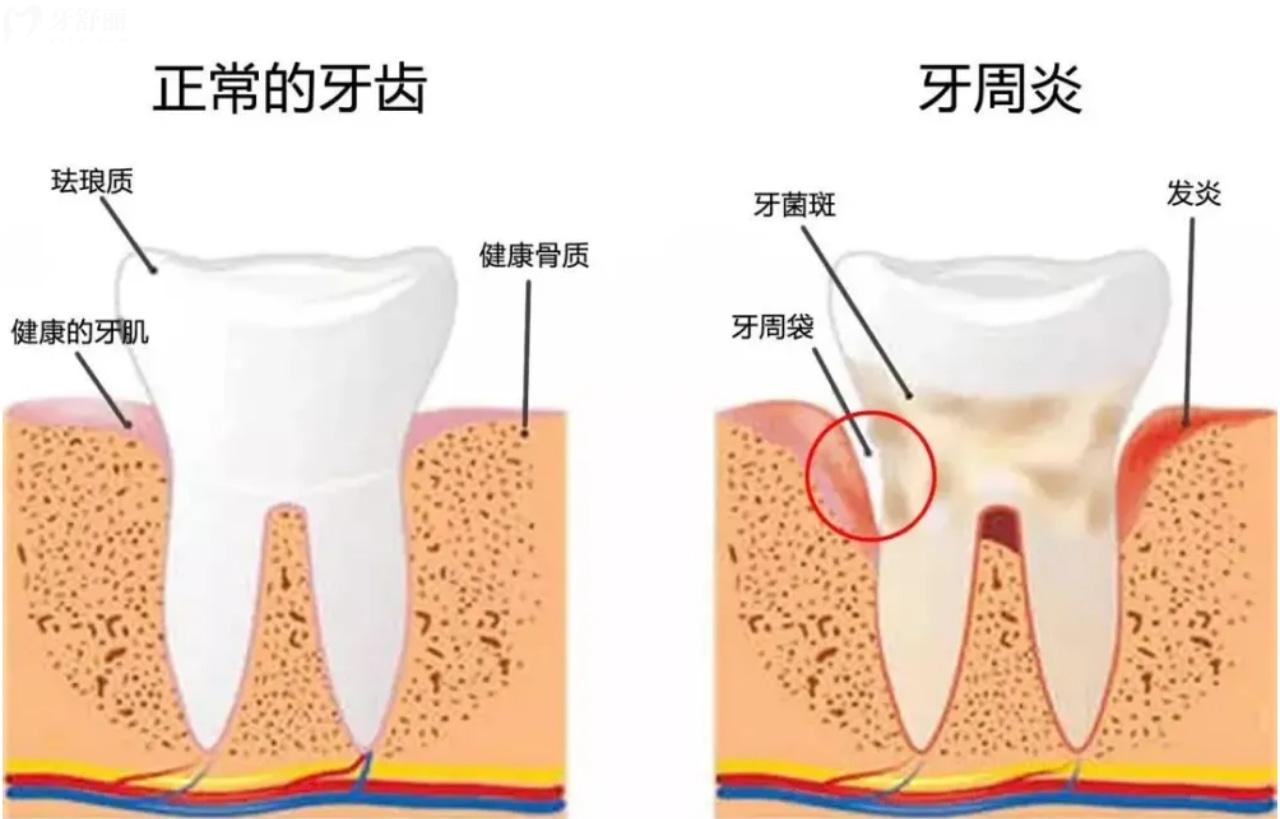 什么是牙周?。? width=