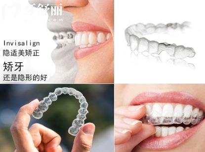 隱形牙齒矯正器