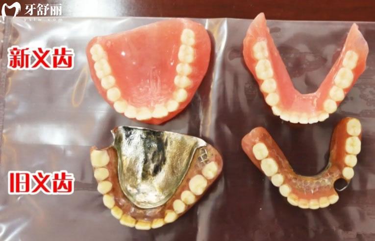 吸附性義齒和普通義齒對比圖