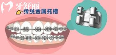 牙齒矯正會(huì)變牙套臉？帶牙套1~12月變化圖