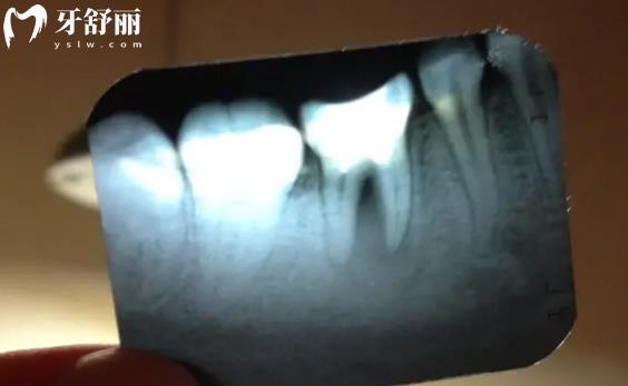 看牙前的檢查太費錢了有必要做嗎 其實這些牙科項目不用拍片