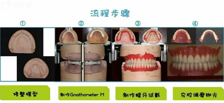 全口吸附性義齒制作流程