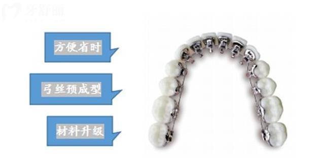 eBrace易美舌側(cè)矯正