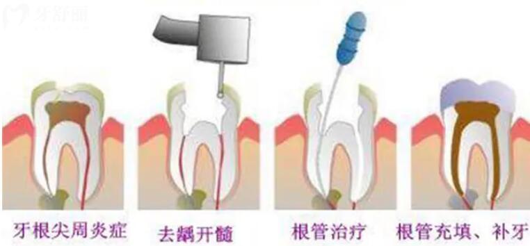醫(yī)生不會說的根管秘密還是拔了