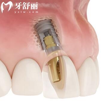 種植牙可以用社保卡報(bào)銷嗎?種植牙一顆多少錢?.jpg