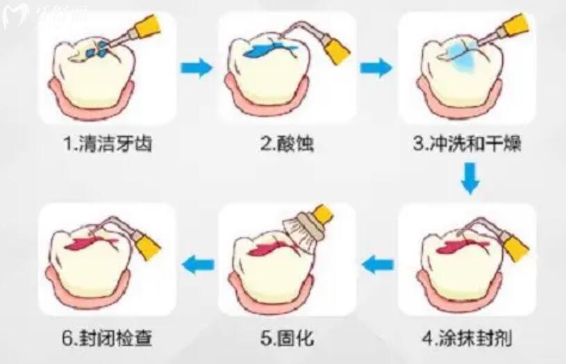 窩溝封閉幾歲做比較適合