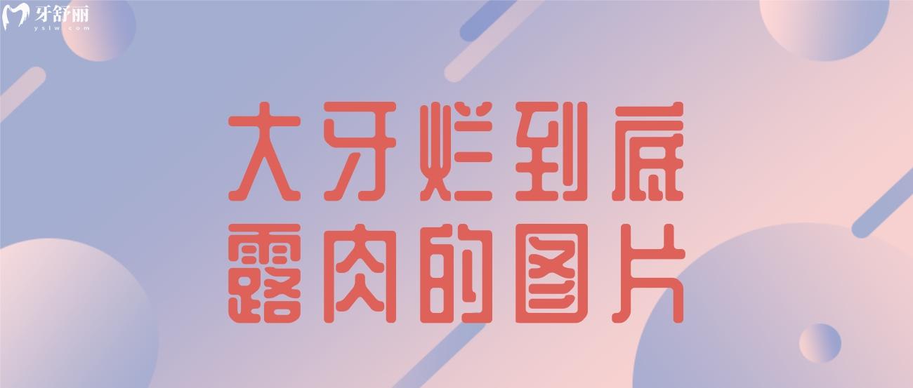 蛀牙已經(jīng)爛空了怎么辦.jpg