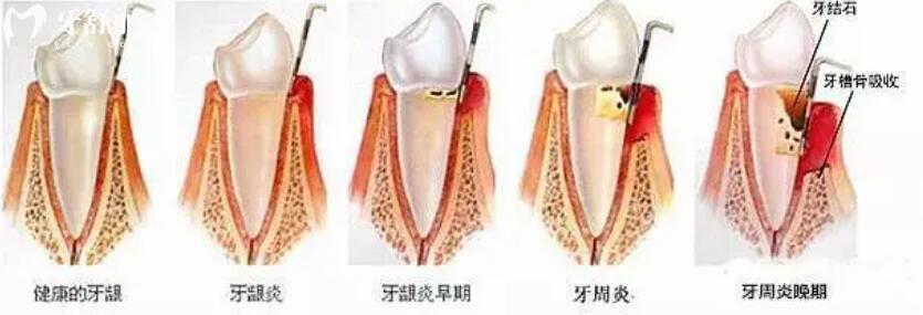 什么是齦下刮治