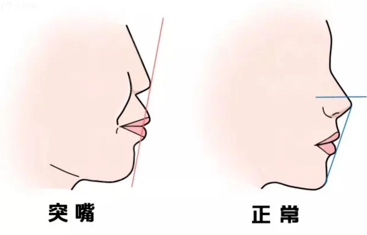 孩子有點齙牙需要矯正嗎？