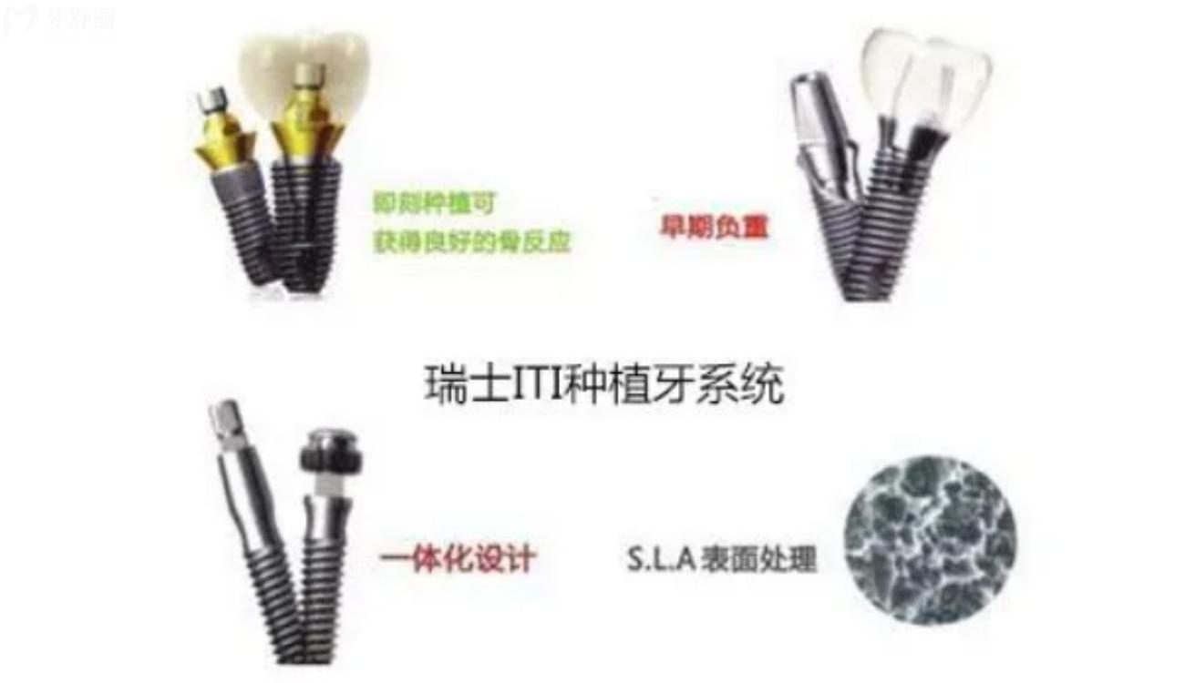 瑞士iTi種植牙是什么.jpg