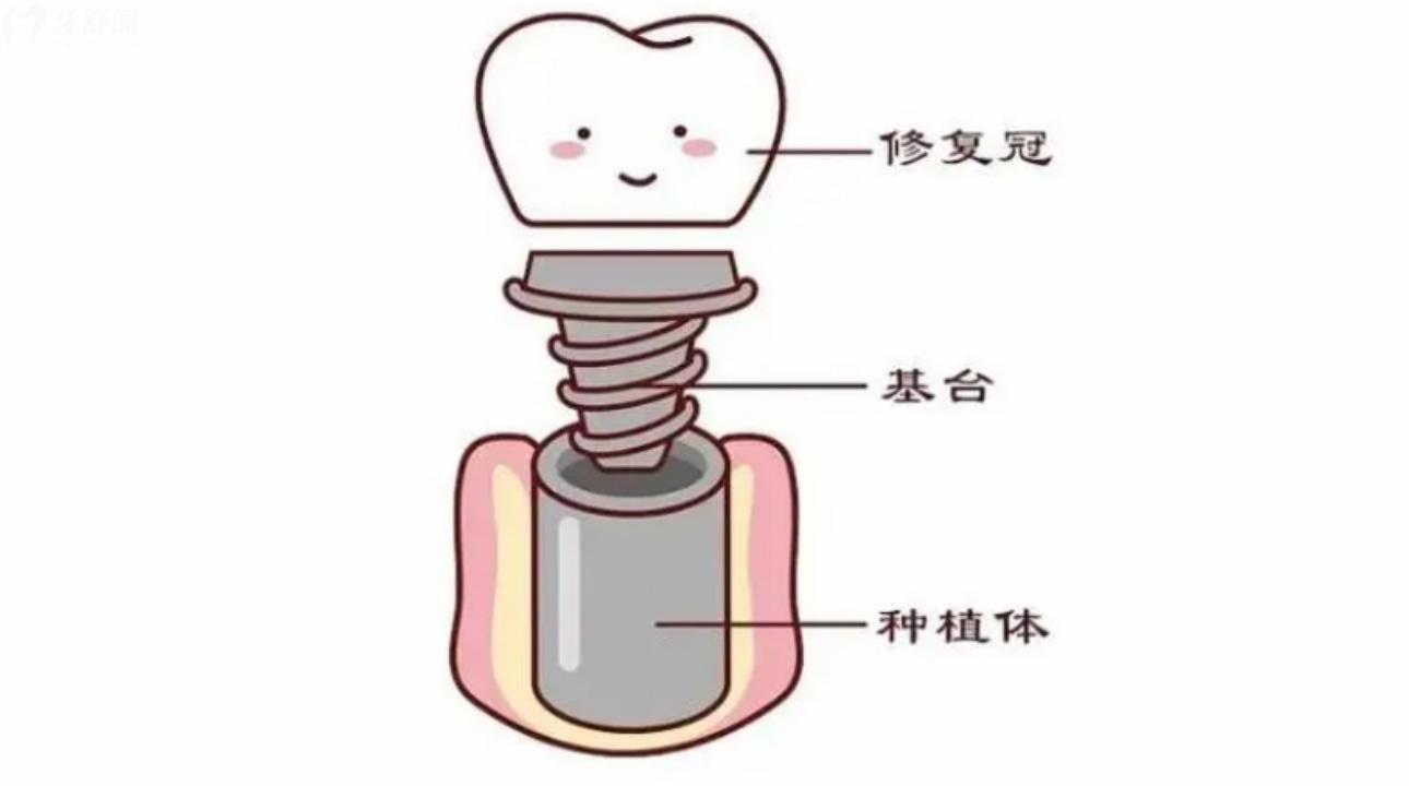 以色列丹特因Dentin種植體