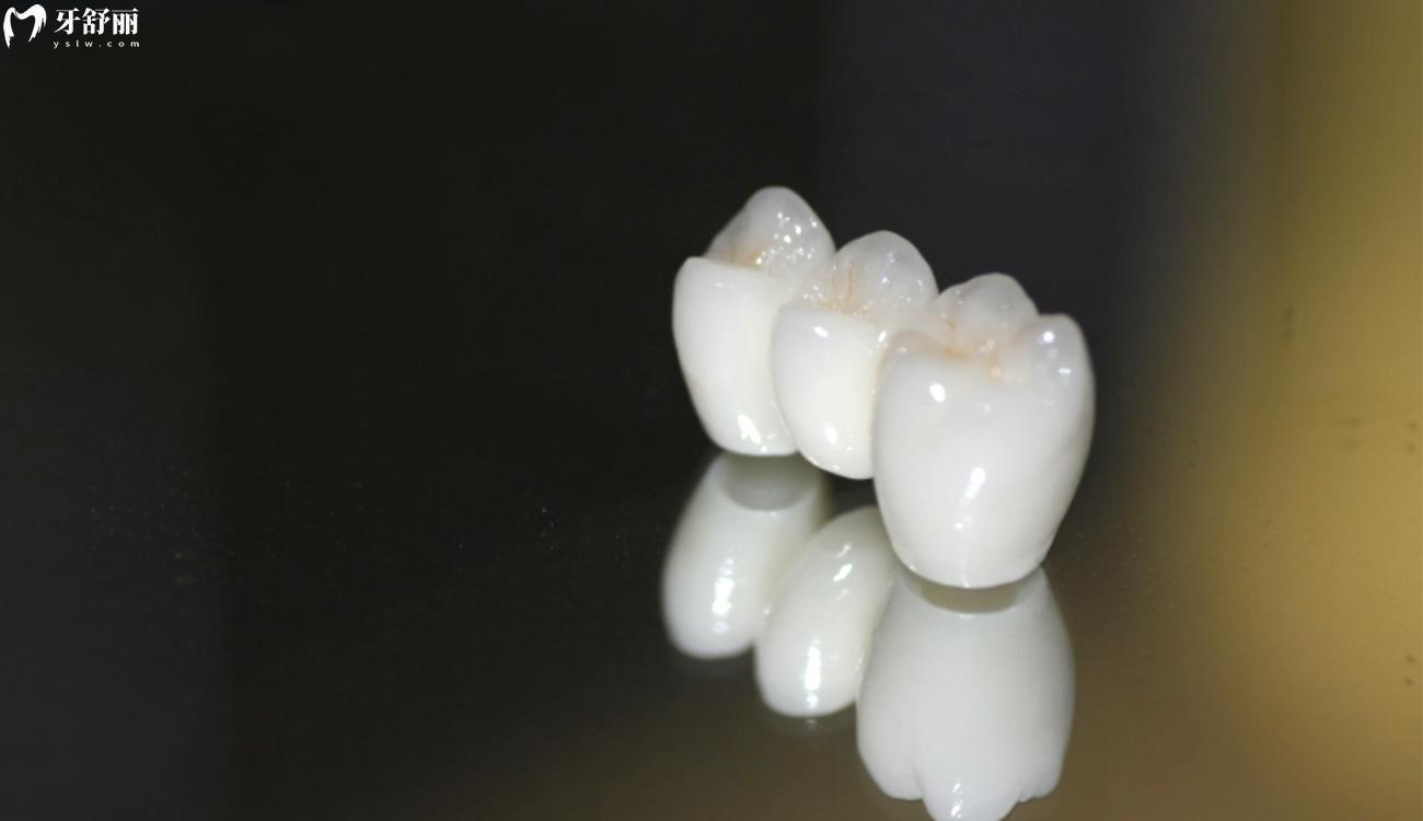 e-max全瓷冠介紹.jpg