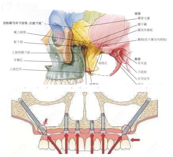 穿顴穿翼種植牙手術(shù)風(fēng)險大嗎？技術(shù)已將成熟了嗎？