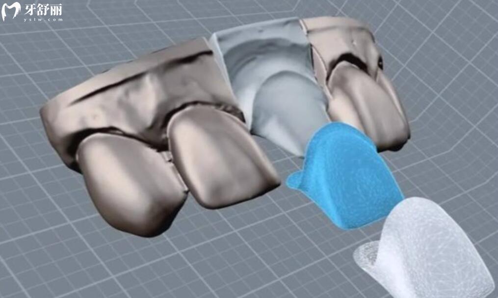 美國3M拉瓦全瓷牙