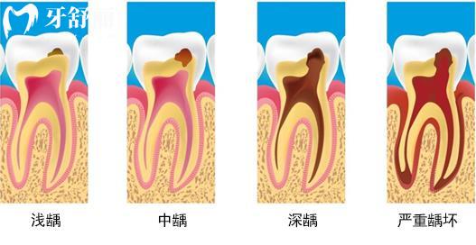 發(fā)起病來難以入眠的牙疼為什么總在深夜開始？