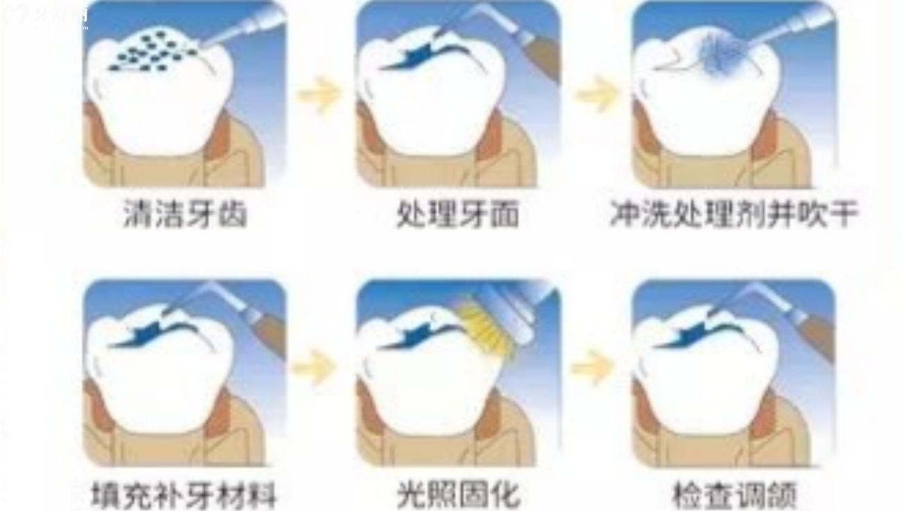 德國voco樹脂材料.jpg