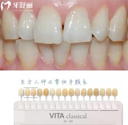 為什么每天認(rèn)真刷牙牙齒還不會(huì)變白？有什么解決辦法？