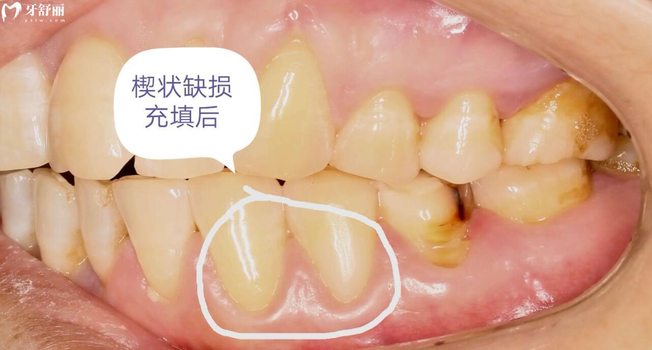 牙齒楔狀缺損醫(yī)生說太淺補(bǔ)不了，會越來越深嗎？還能自愈嗎