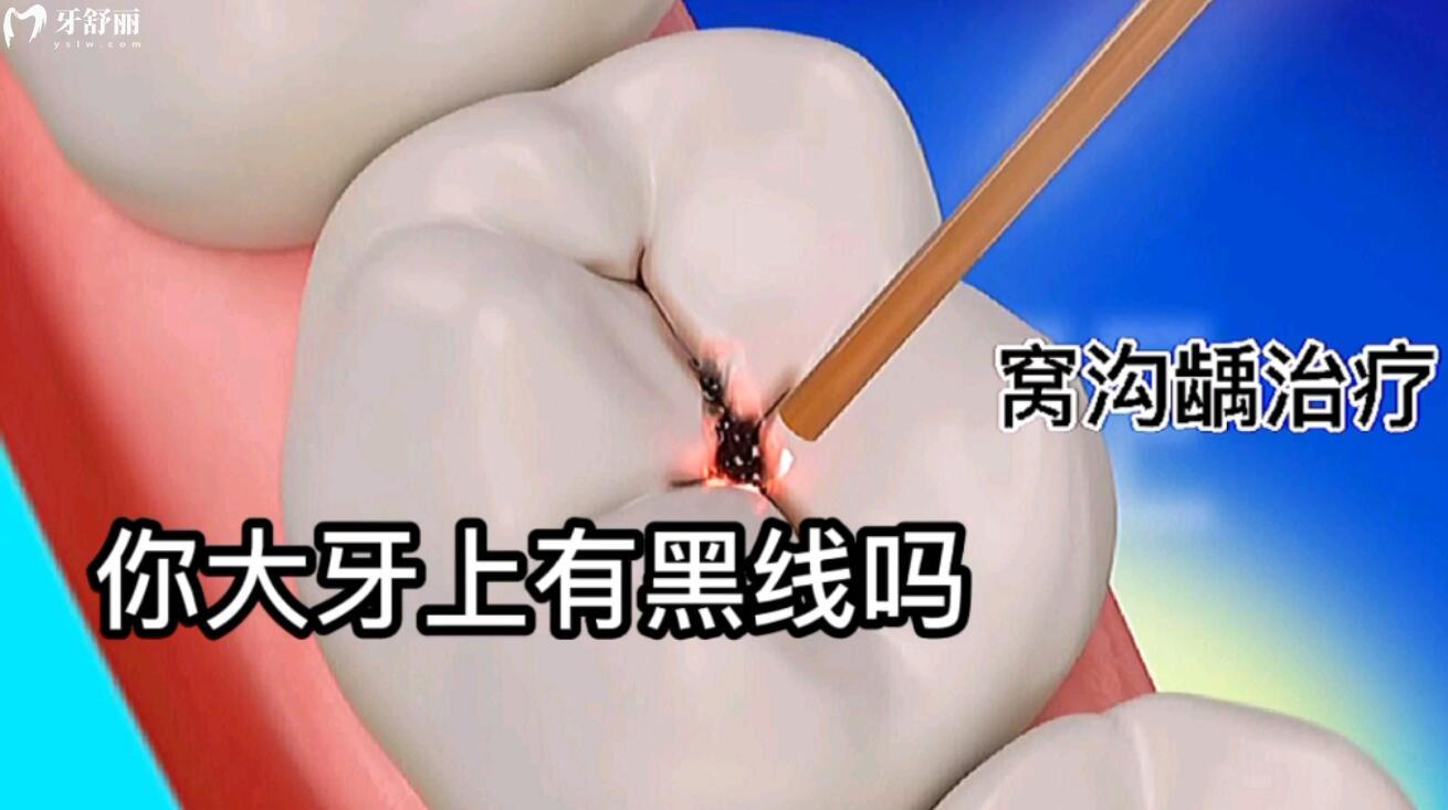 牙齒上的黑線一定是蛀牙嗎？一定要補牙治療嗎