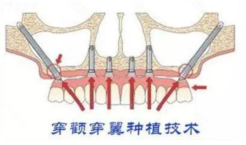 穿顴穿翼種植術