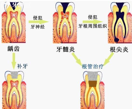 牙疼為何如此劇烈，牙疼的原因到底是什么？