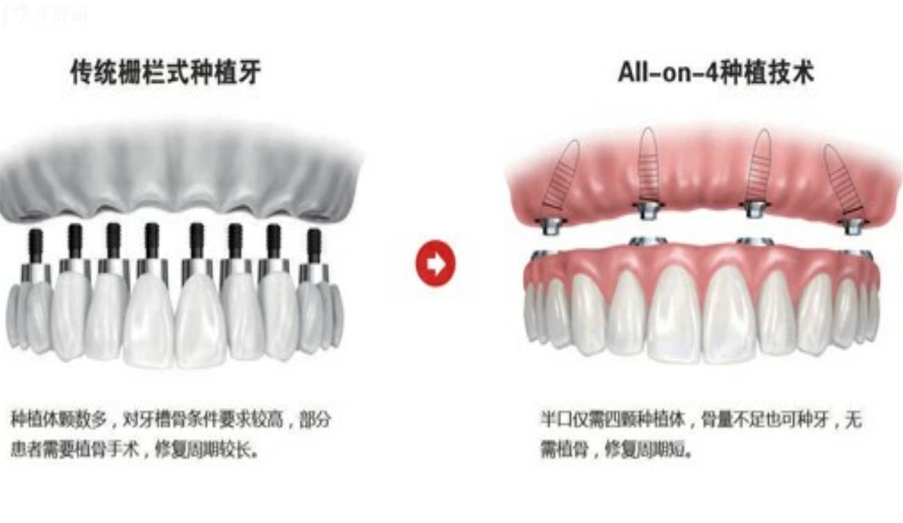 All-on-4/6種植技術(shù).jpg