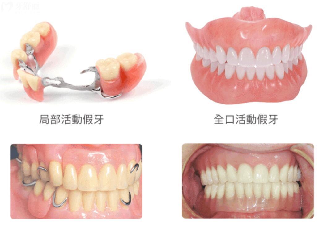 假牙用什么材料好?價(jià)格有啥不同?應(yīng)該怎么選擇才性價(jià)高