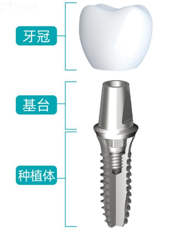 德國(guó)卡姆洛種植體