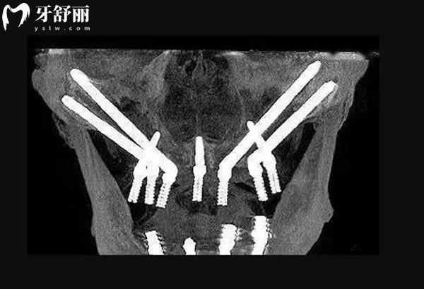 蚌埠種植牙多少錢一顆