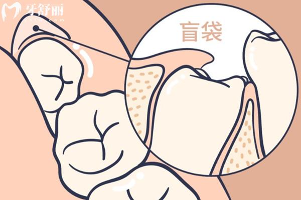 智齒盲袋