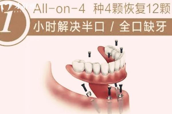 all-on-4半口種植牙