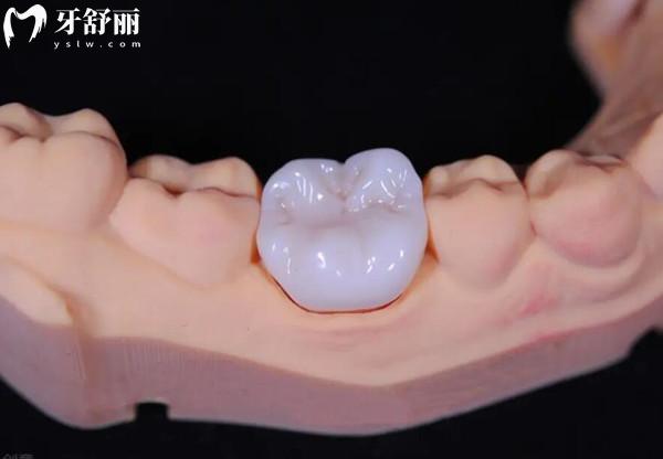 烤瓷牙圖片