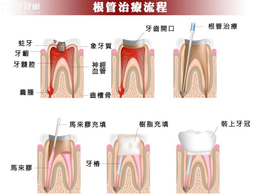 根管治療后不戴牙冠，會出現(xiàn)什么情況？
