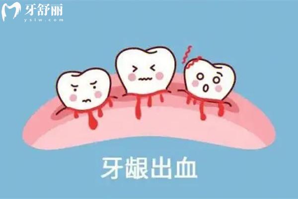 牙齦出血