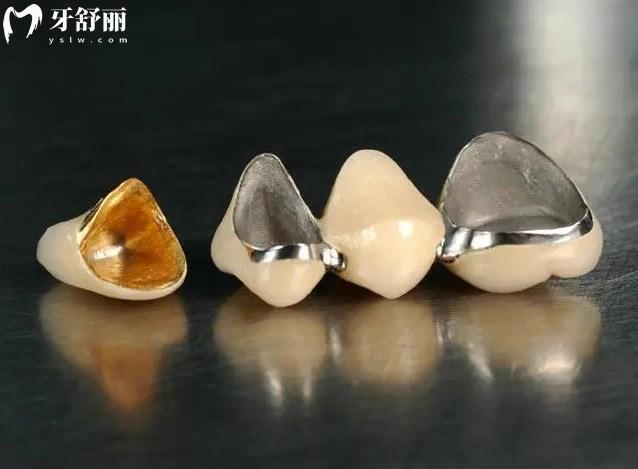 鑲牙冠