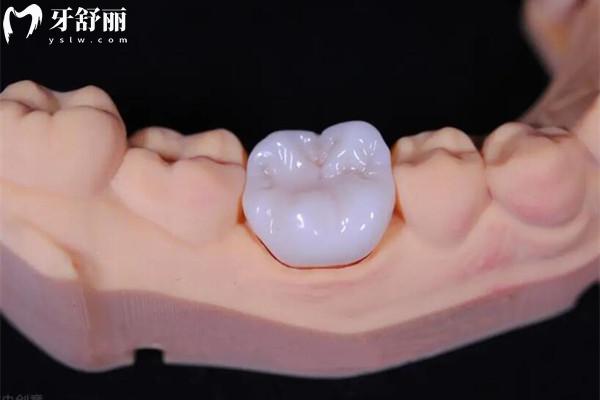 全瓷牙冠