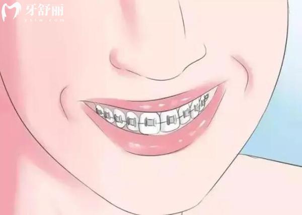 麗水名禾口腔牙齒矯正價(jià)格