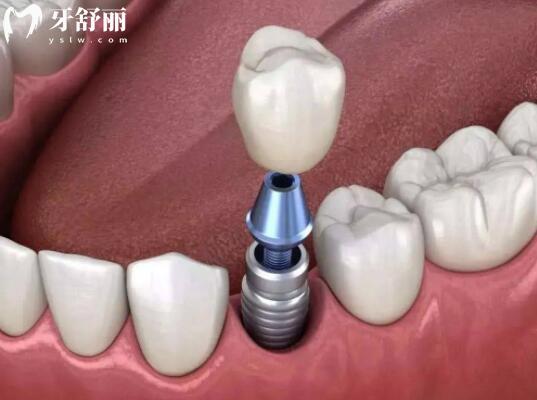 ?？谘揽漆t(yī)院收費標準翻新,拔智齒350+種植牙2600+矯正5800+