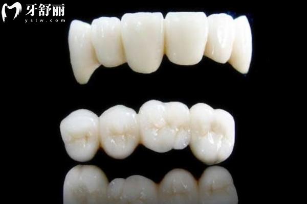 威蘭德ZENOSTAR臻瓷全瓷牙冠